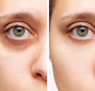 DARK CIRCLES: Causes, TIPS, Prevention