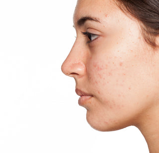 ACNE 101